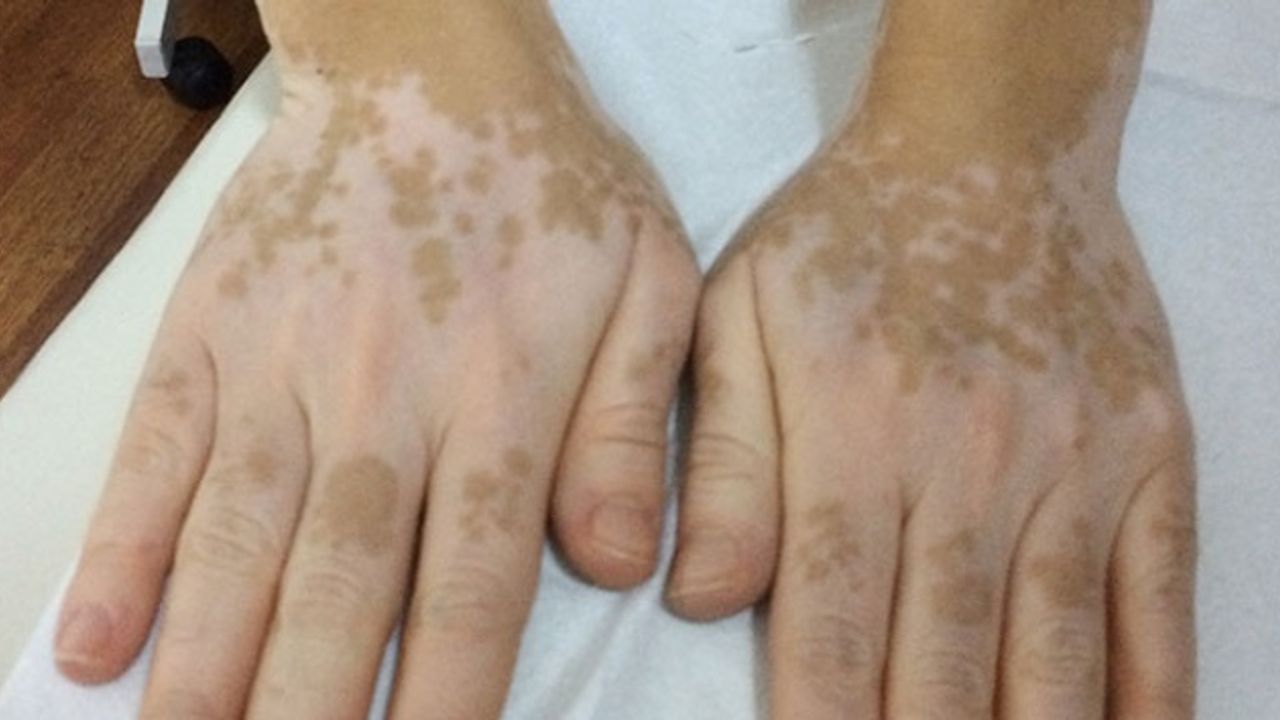Vitiligo Hastalığı Dünyanın Yüzde Birini Etkiliyor!