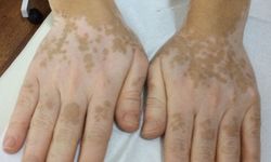 Vitiligo Hastalığı Dünyanın Yüzde Birini Etkiliyor!