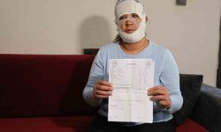 Güzelleşmek İsterken Kabusu Yaşadı! Yüzü Yanıklarla Kaplandı
