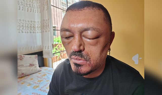 Adana’da Şampuan Faciası: Yüzü Şişti, Hastanelik Oldu!